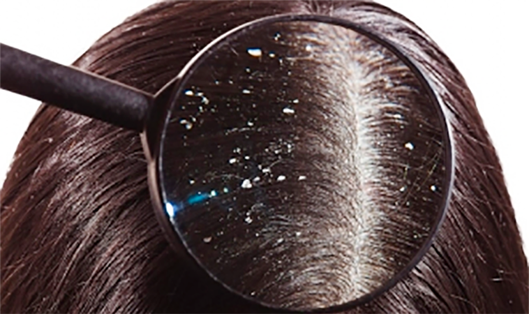 Tóc bạn đang bị gàu, ngứa hoặc nấm tóc, làm sao để khắc phục?
